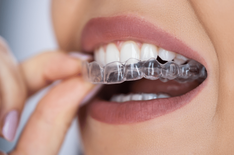 The Ultimate Guide to Invisalign Attachments: What You Need to Know