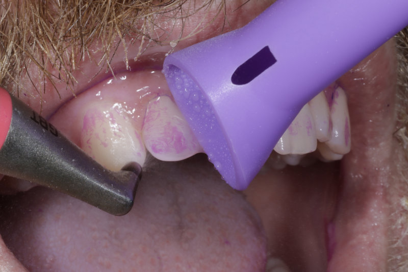 EMS airflow disclosing agent removal