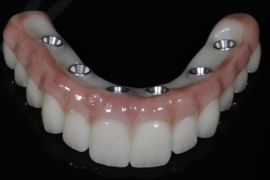 All-on-X 2 maxillary hybrid denture 1