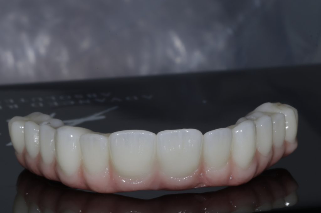 All-on-X 3 maxillary hybrid denture 2