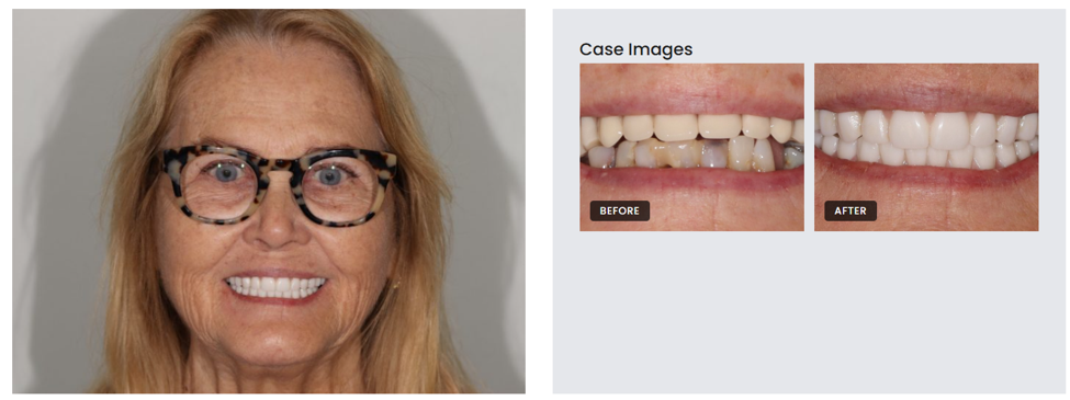 Dental Implants 1 patient case on or before
